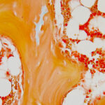 CD34+ bone marrow histology