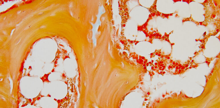 CD34+ bone marrow histology